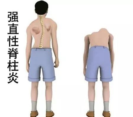 强直性脊柱炎是如何引起驼背的呢